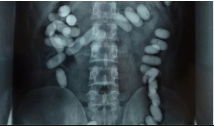 مصالح الديوانة بمطار تونس قرطاج تحبط محاولة تهريب 18كبسولة “زطلة” بأمعاء مسافرين