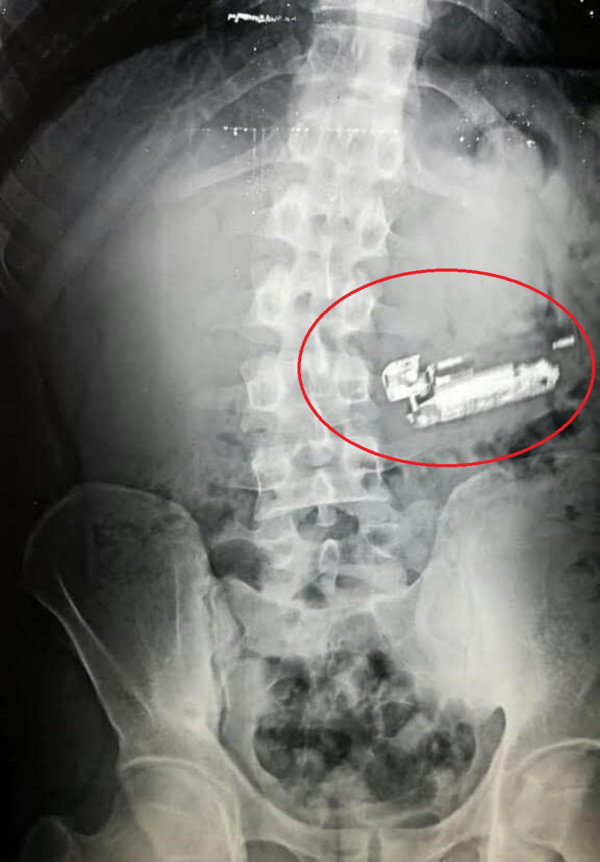 هاتف وولاعة سجائر في بطن مريض