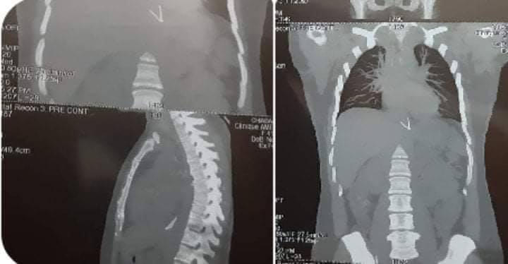 كادت أم الـ 3 أبناء تموت بسبب قطعة حديد في baguette farcie