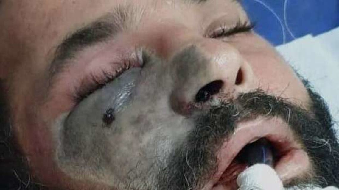 منظمة الصحة: الاستخدام المكثف لأدوية كوفيد 19 يسبب الإصابة بالفطر الأسود