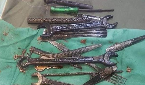 القصرين/ استخراج مفاتيح براغي وشوكات أكل من بطن مواطن