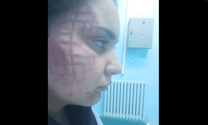 يحدث في تونس/ يضرب شقيقته 20 ضربة بشلاكة على وجها لأنها ذهبت لمركز تجميل (صور)