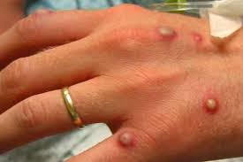 تسجيل أول إصابة بجدري القردة في الجيش الإسرائيلي 