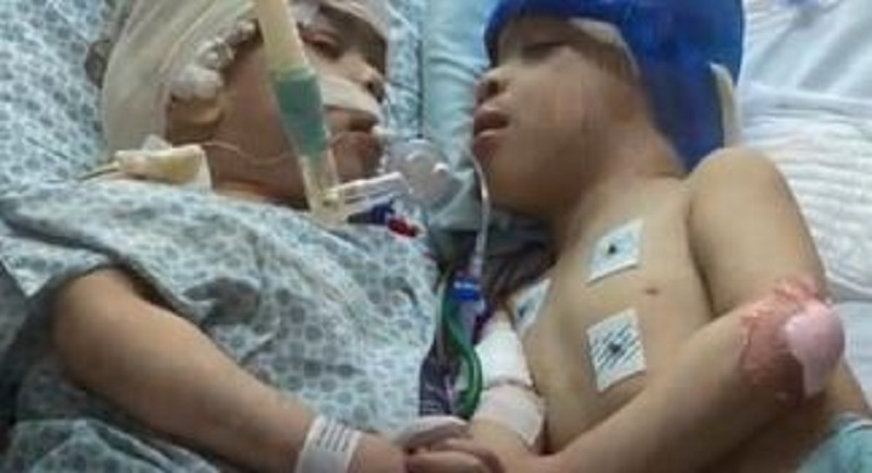 شاهد الفيديو/ في عملية معقّدة.. فصل توأم ولدا ملتصقين من الرأس