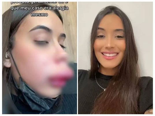 عملية تجميل فاشلة تشوه وجه فتاة بشكل غريب!