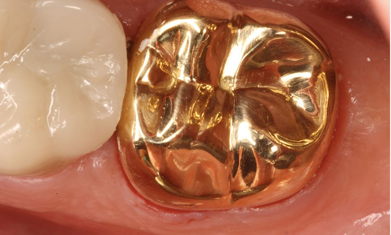 مُمرّض يستولي على ضرس ذهبي لمتوفّي بالمستشفى