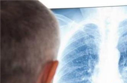 الالتهاب الرئوي