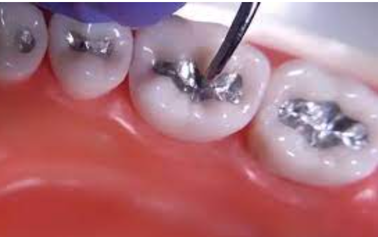 ملغم الاسنان