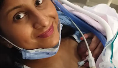 شاهد/ توأم بحجم كف اليد يدخل موسوعة غينيس (فيديو)