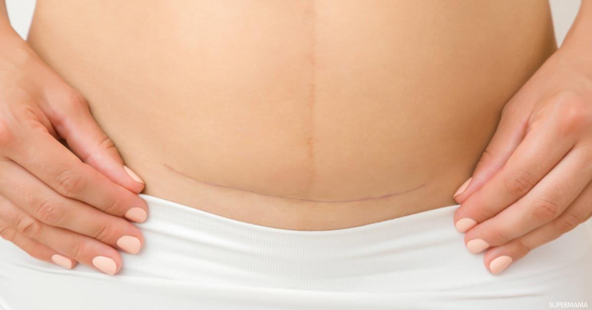 شاهد/ أغرب عملية قيصرية على الإطلاق