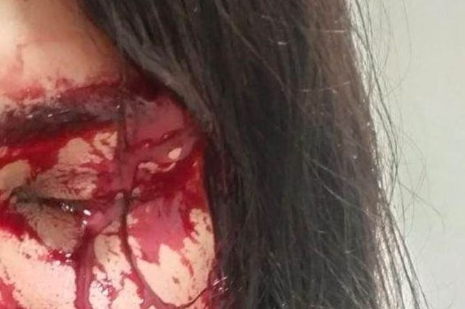 خربوا عينها بشقف/ “ترافاستي” تفقد عينها