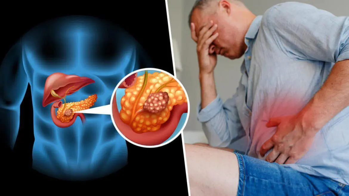 علامات لا تتجاهلها.. إنذار مبكر بسرطان البنكرياس