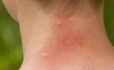 توزر/ فريق صحي لتقصي فيروس حمى غرب النيل