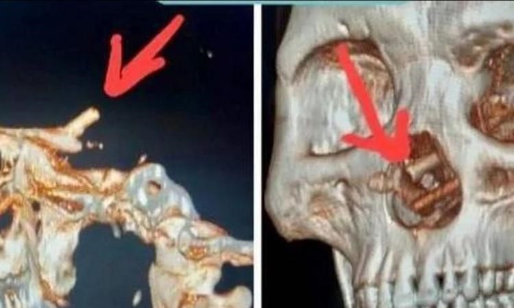 كيف تسربت؟! رجل يكتشف عيدان طعام داخل جمجمته كيف تسربت؟! رجل يكتشف عيدان طعام داخل جمجمته