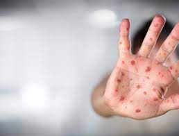 الحصبة تعود بقوة لأوروبا والصحة العالمية تحذر