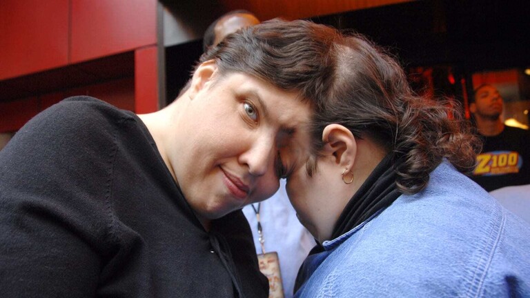 وفاة أكبر توأم ملتصق في العالم (صور)