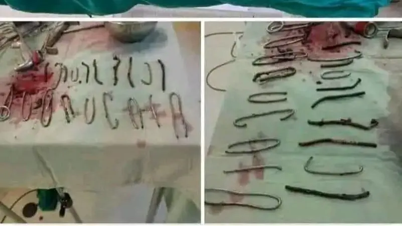 استخراج 20 مسماراً من بطن مريض بالجزائر (صور)