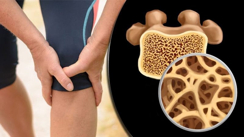 7 نصائح للوقاية من هشاشة العظام