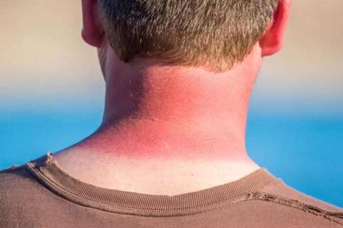 الإسعافات الأولية الضرورية عند التعرض لحروق الشمس الإسعافات الأولية الضرورية عند التعرض لحروق الشمس