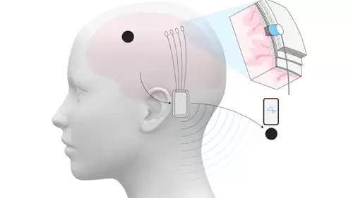 ماسك إثر نجاح جديد لزرع شريحة دماغية: انتظروا المزيد