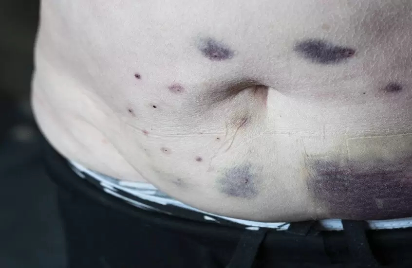 كدمات على الجسم لا ينبغي تجاهلها