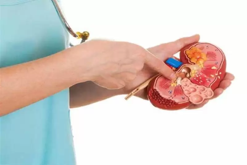  علاجات طبيعية قد تخلصك من حصوات الكلى11