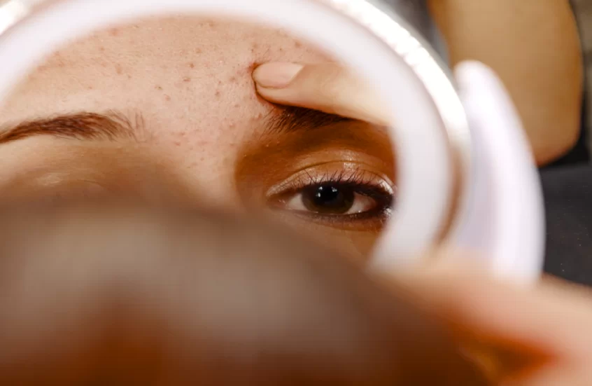 أمل جديد للمراهقين.. تطوير لقاحين لعلاج حب الشباب ومنعه أمل جديد للمراهقين.. تطوير لقاحين لعلاج حب الشباب ومنعه