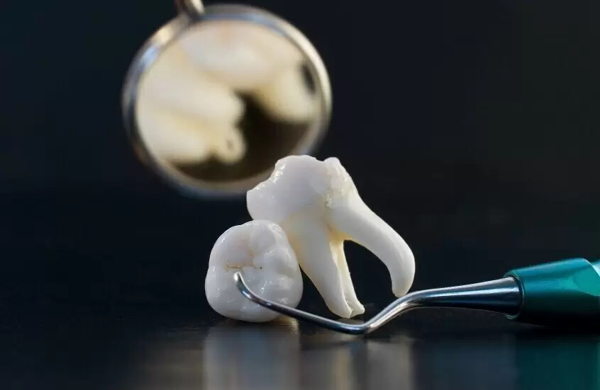 اكتشاف تأثير غير متوقع لقلع أضراس العقل اكتشاف تأثير غير متوقع لقلع أضراس العقل