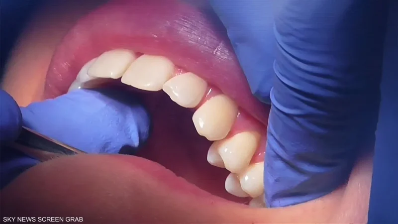 علماء يطورون هلاما لإصلاح الأسنان التالفة دون جراحة